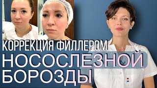 Коррекция Филлером НОСОСЛЕЗНОЙ БОРОЗДЫ 💦👃 ФИЛЛЕР под Глаза 👀 Как убрать НОСОСЛЕЗНУЮ БОРОЗДУ [upl. by Naiva]