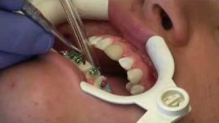 Just Orthodontics  How we put Damon Q braces on your teeth [upl. by Anaihsat]