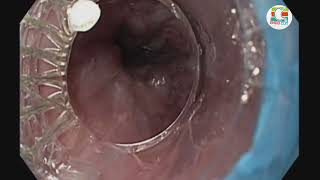 Endoscopic Variceal Ligation EVLব্যান্ড লাইগেশন  ইবিএল Endo Cut [upl. by Maribel]