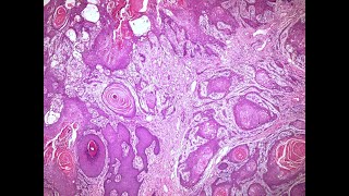 Neoplasia II Malignant epithelial tumors histopathology slides [upl. by Netneuq131]