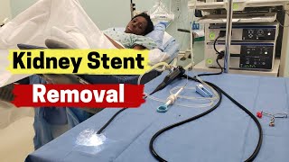 Kidney Stent Removal  What is Involved in Kidney Stent Removal [upl. by Ob52]