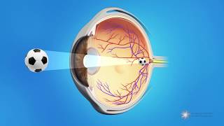 Posterior Capsule Opacification PCO  Also known as Secondary Cataracts or Cataract Scar Tissue [upl. by Hazlett]