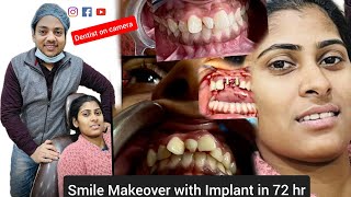 Smile Makeover in 3 days with Corticobasalimplant amp Zirconia crowns  Dr Mangal Gupta [upl. by Ainoval]