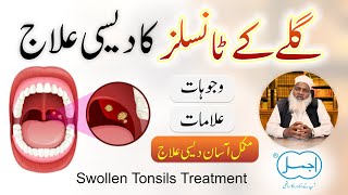 Tonsils ka ilaj  Galay Ki Gadood Ka ilaj  Swollen Tonsils Causes amp Herbal Treatment in Urdu [upl. by Ahsinak]