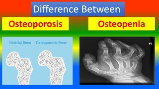 OSTEOARTHRITIS VS OSTEOPOROSIS VS OSTEOMALACIA DIFFERENCES MADE EASY [upl. by Bernardina348]