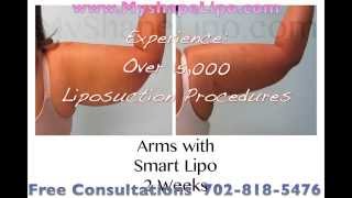 Arms Liposuction Before and After MyShape Lipo [upl. by Santana918]