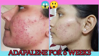 I USED ADAPALENE FOR 6 WEEKS AND THIS HAPPENED😱🤯 MY EXPERIENCE HOW TO USE KHUSHI MAHLA [upl. by Ennasus]