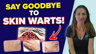 Say Goodbye to Skin Warts Causes Types and Effective Solutions  What Are Warts [upl. by Longwood]