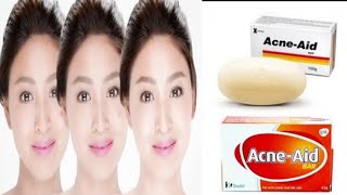 Acne  Aid Soap  Best medicated soap foroily and acne skin [upl. by Greenlee]