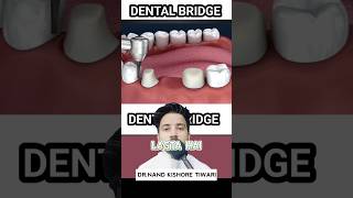 Dental BRIDGE procedure  Dental BRIDGE kaise BANTA HAI ❓shorts dental [upl. by Annohsal]