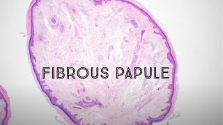 Fibrous papule angiofibroma skin bump on nose mimic of basal cell carcinoma pathology dermpath [upl. by Layla]