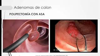 Adenomas de colon [upl. by Jann]