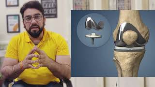 OA knee braces perfect alternate of kneesurgey for osteoarthritis patient घुटने के दर्द से राहत [upl. by Alguire]