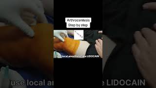 Arthrocentesis part 1 [upl. by Ofilia375]