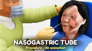 Nasogastric NG Tube Procedure  3D animation [upl. by Yennek]