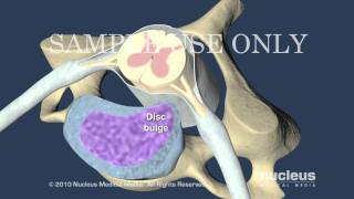 Cervical Disc Herniation [upl. by Arraet]