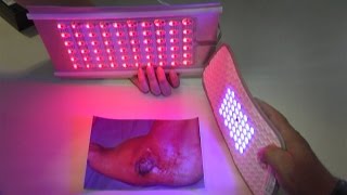 Medilight  Lichttherapie gegen chronische Wunden [upl. by Nanreik]