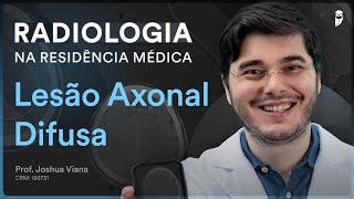 Lesão Axonal Difusa  Radiologia na Residência Médica [upl. by Standing]