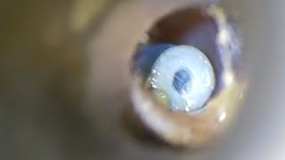 Gruesome Footages Shows Removal Of Ear Grommets [upl. by Eilegna80]