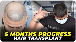 Hair Transplant in Varanasi  Best Results amp Cost of Hair Transplant in Varanasi [upl. by Nennek]