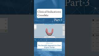 Clinical Indications Crossbite Part 3 [upl. by Pas]