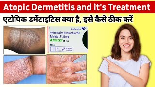 Atopic dermatitis treatment in hindi  hydralazine 25 mg tablet  Atarax injection  baby dermatitis [upl. by Nameloc]