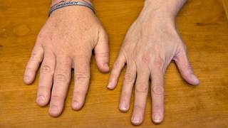 Difference Between Gigantism and Acromegaly [upl. by Ailel]