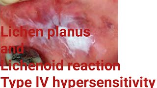 Difference between Lichen planus and Lichenoid reaction pathogenesis of lichen planus and lichenoid [upl. by Ahsinelg]