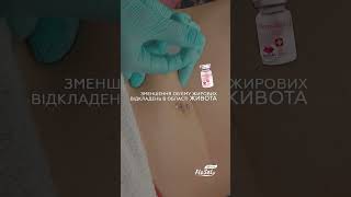 Корекція локальних жирових відкладень в ділянці живота Dermaheal LL мезотерапія [upl. by Isus]