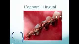 Orthodontie linguale comment survivre  Tutorial HQ [upl. by Carmela]