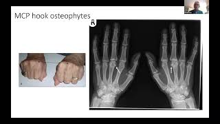 Genetic Haemochromatosis  Joint pain and arthropathy with Professor Patrick Kiely [upl. by Keldon482]