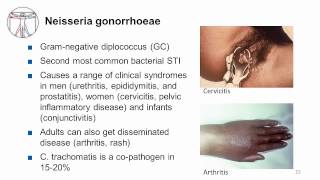 Syphilis Urethritis and Cervicitis [upl. by Lona139]