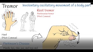 Tremor  Shaking hands hand tremors Causes and treatment Parkinson or Physiological Tremor [upl. by Aekim428]