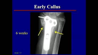 Normal Fracture Healing imaging findings [upl. by Liagabba991]