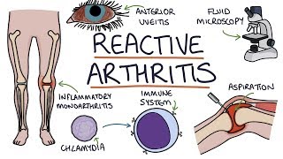 Understanding Reactive Arthritis [upl. by Dnomar]