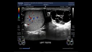 Ultrasound Video showing an Epididymal cyst [upl. by Mastrianni995]