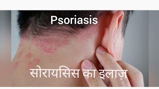 Psoriasis सोरायसीस psoriasis psoriasiscure psoriasissolution psoriasiscauses psoriasisdiet [upl. by Bellaude]