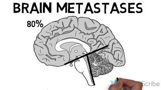 Brain Metastases [upl. by Ap4]