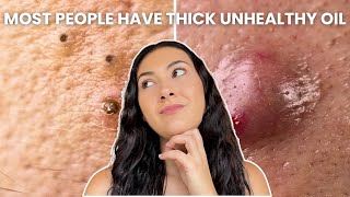 How To Treat Every Type of Acne Comedones Nodules Cysts [upl. by Nnaarual857]