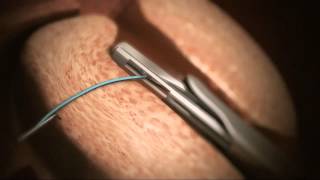 Animation of Urolift® System for BHP  Treatment now available at Genesis Healthcare [upl. by Muire]