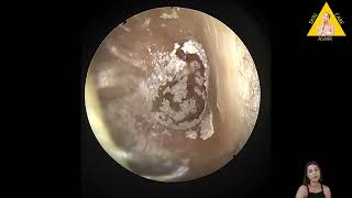 Ear wax removal ear wax removal asmr ear wax removal india ear wax removal videos ear wax remova [upl. by Elonore]