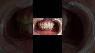 Treatment of Pyorrhea  Pyria ka ilaaj  PeriodontitisDrPratibha shorts viral dental trending [upl. by Ira473]