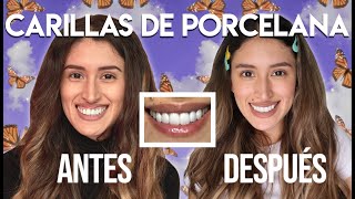 Carillas Dentales de Porcelana Antes y Después Mi Experiencia Paso a Paso y Más [upl. by Shelby]