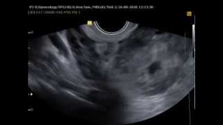 Misdiagnosed ectopic pregnancy mimicking adnexal malignancy a report of two cases [upl. by Crescint]