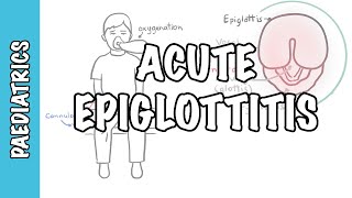 Acute Epiglottitis  signs and symptoms causes pathophysiology treatment [upl. by Hajidahk]