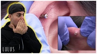 Massive Crust Build Up On Ear Piercing Removal  Ep 369 [upl. by Sevik]