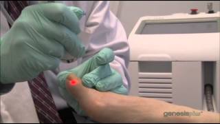 Laser Nail Fungus Treatment With the Cutera Genesis Plus [upl. by Atiuqcaj710]