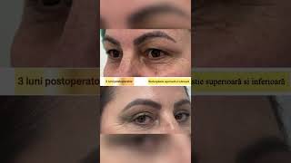 BLEFAROPLASTIE ❤️‍🔥 înainte și după 3 luni de zile ➜ de la operația făcută la Clinica Dr Levy [upl. by Blount158]