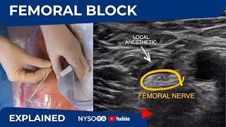 UltrasoundGuided Femoral Nerve Block  Regional anesthesia Crash course with Dr Hadzic [upl. by Pampuch]