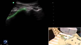 How To Ultrasound Guided Sacroiliac Injection  Sonosite Ultrasound 3D Video [upl. by Salomo]